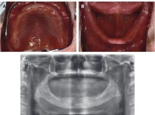 Fig. 1. Preoperative view (A) upper, (B) lower intraoral photo, (C) panoramic view.