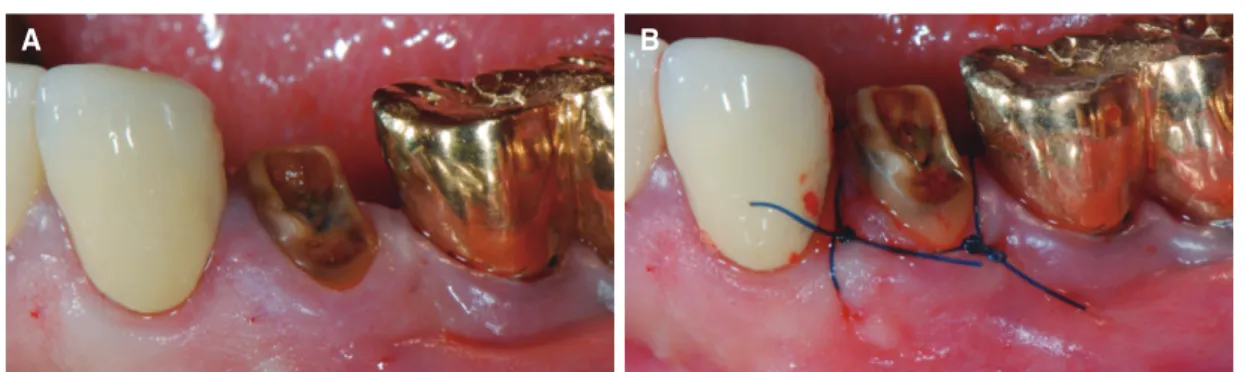 Fig. 7. Decision flow for the selection of a optimal method among clinical crown lengthening procedures.