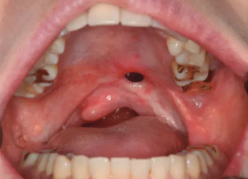 Fig. 1. Intraoral photos. (A) Maxillary dentition, (B) Mandibular dentition.