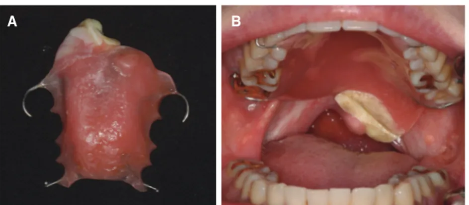 Fig. 4. Inner surface of palatal lift prosthesis  after additional relining with Coe-comfort.