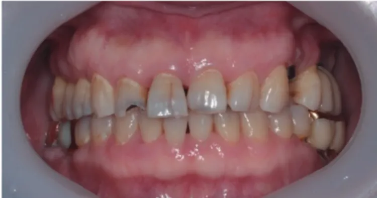 Fig. 4. Gingival line analysis.