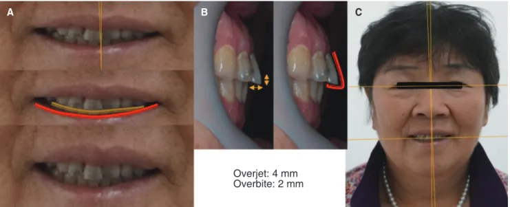 Fig. 6. (A) Smile line, (B) Overjet, (C) Median line analysis.