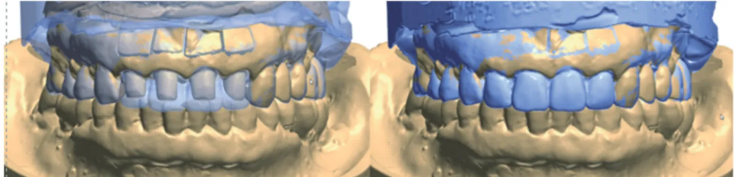 Fig. 8. Definitive prosthesis by double scanning of 2 nd  provisional restoration.
