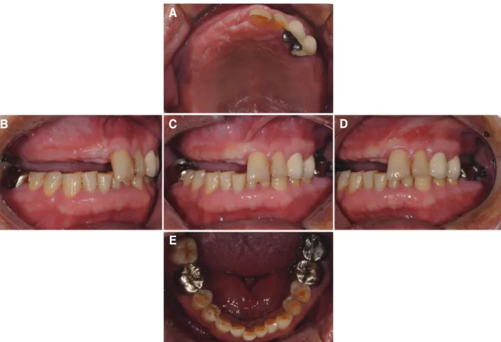 Fig. 1. Pretreatment state. (A) Maxillary occlusal view, (B) Right lateral view, (C) Frontal view, (D) Left lateral view, (E) Mandibular occlusal view.