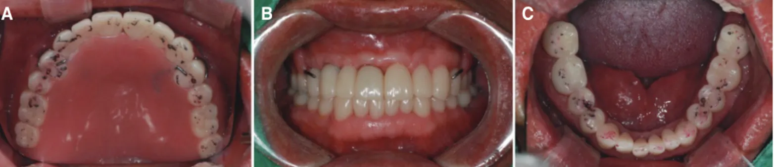 Fig. 5. Provisional restoration setting. (A) Maxillary occlusal view, (B) Frontal view, (C) Mandibular occlusal view.