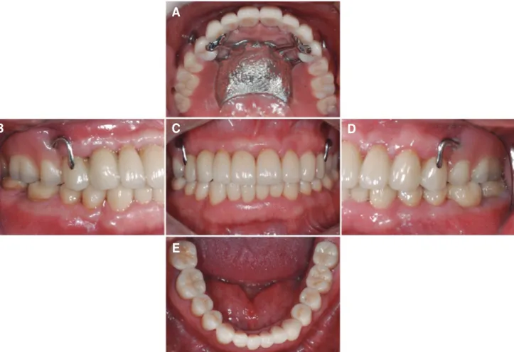 Fig. 8은 최종의치가 장착된 구강 내 모습이다. 의치 장착 2주  후  지르코니아 대합치에 의한 인공치 교합면 마모를 예방하기  위해 인공치에 아말감을 적용하였다 (Fig