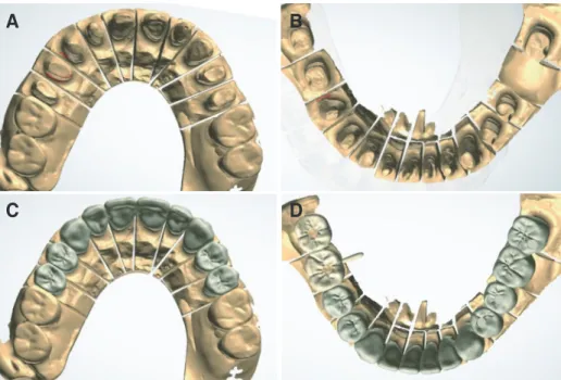Fig. 7. Computer-aided design. (A) Scan of upper teeth, (B) Scan of the lower teeth, (C) Full contour of upper teeth, (D) Full contour of lower teeth.