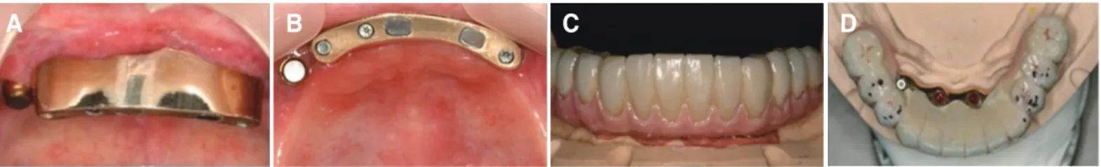 Fig. 4. Radiographic view. (A) Panoramic view. Generalized alveolar bone resorption is observed, especially on implant near mandibular right canine region, (B)  Periapical view on implants placed on mandibular both central incisor area.