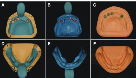 Fig. 6. Final impression taking (B, E) with individual tray (A, D), and definitive cast fabrication (C, F).