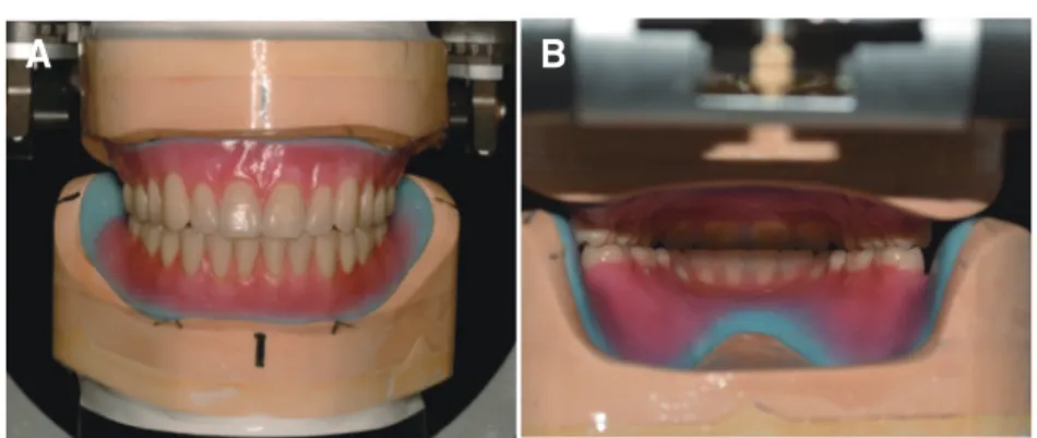 Fig. 7. Wax trial denture. Bilaterally balanced occlusion achieved with lingualized occlusion
