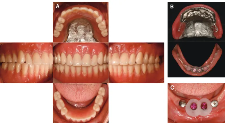 Fig. 10. (A) Definitive implant overdenture, (B) Intaglio of maxillary and mandibular overdenture, (C) Female housing and separator of attachment before direct  resin application