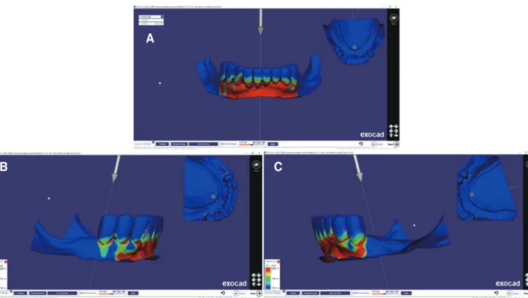 Fig. 6. Electronic surveying on mandibular surveyed crowns shows ideal undercut degrees of retentive arms