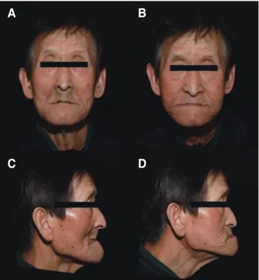 Fig. 3. Existing denture analysis. (A) Poor denture hygiene, (B, C, D) Com- Com-parison of existing denture with diagnostic study casts.
