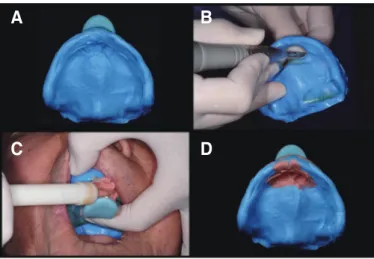 Fig. 6. Test of mastication ability using color changeable chewing gum. (A)  Before mastication, (B) Mastication result of existing denture, (C)  Mastica-tion result of temporary denture, (D) Color chart.