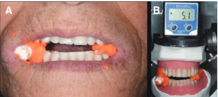 Fig. 11. Denture tilting test. (A) Cotton roll bite and impression taking with  bite impression material, (B) Angle measurement.