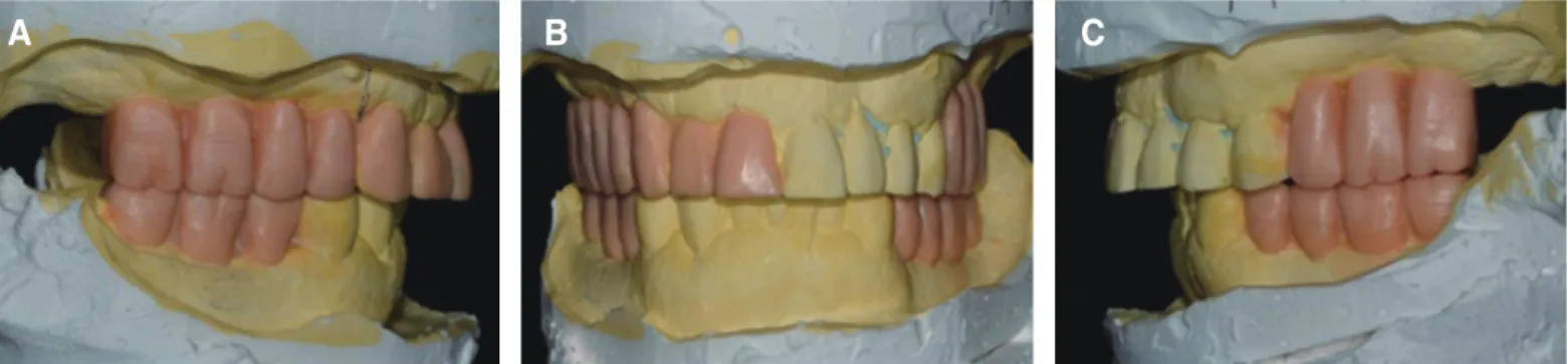 Fig. 3. Diagnostic wax up model with new occlusal vertical dimension. (A) Right lateral view, (B) Frontal view, (C) Left lateral view.