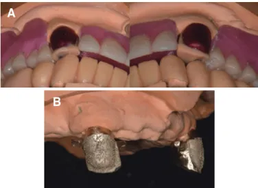 Fig. 12. Occlusal gap between inner and outer crown. Fig. 13. (A) Centric and eccentric occlusion on metal, (B) Retentive structure.