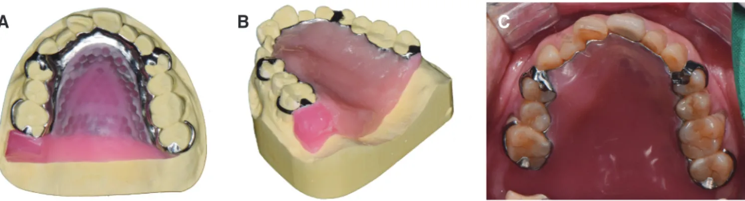 Fig. 7. Palatal Space, (A) - (D)  With prosthesis, (E) - (H) Without  prosthesis.