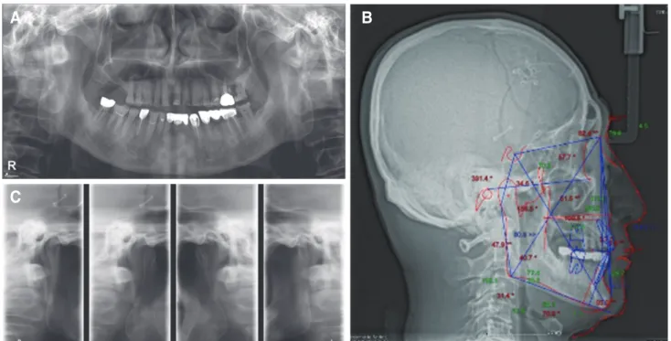 Fig. 3. Diagnostic wax-up cast model.