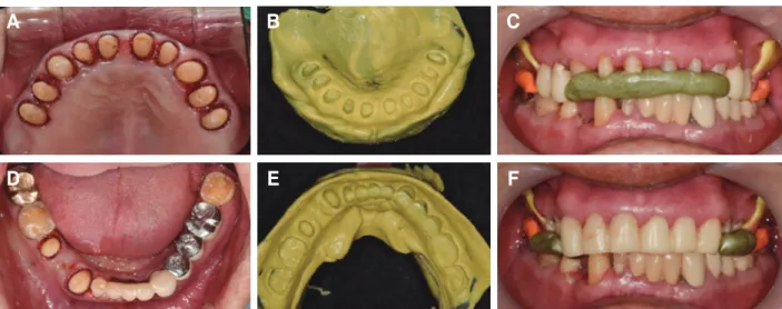 Fig. 5. (A, D) Tooth preparation, (B, E) Final impression, (C, F) interocclusal relationship registrations using provisional restorations.