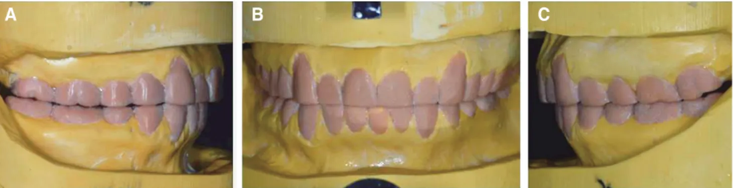 Fig. 5. Diagnostic wax up. (A) Right, (B) Frontal, (C) Left.