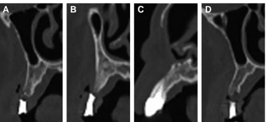 Fig. 3. The CBCT images at the maxilla. (A) #16, (B) #15, (C) #13, (D) #26.