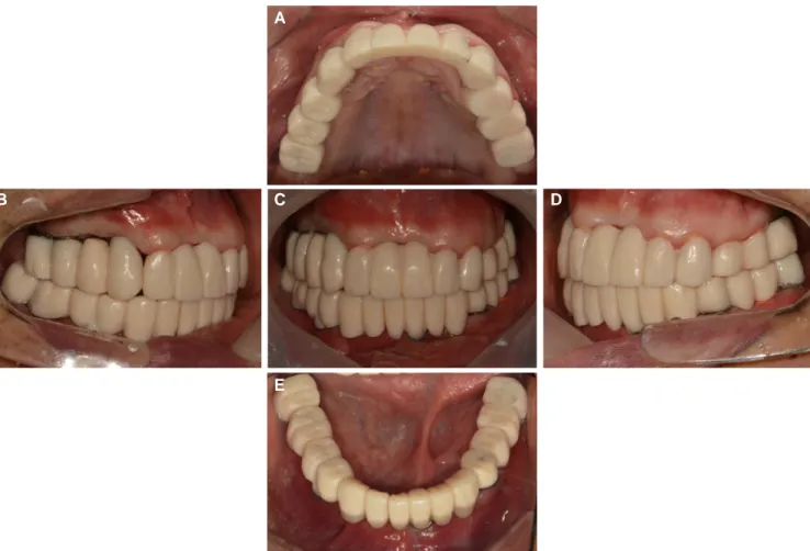 Fig. 7. Provisional prostheses. (A) Maxillary occlusal view, (B) Lateral view (right), (C) Frontal view, (D) Lateral view (left), (E) Mandibular occlusal view.