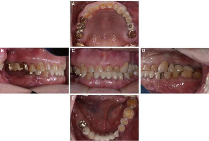 Fig. 3. Panoramic radiograph before treatment. Fig. 4. Diagnostic wax-up with an increase of 2.0 mm of incisal guide pin.