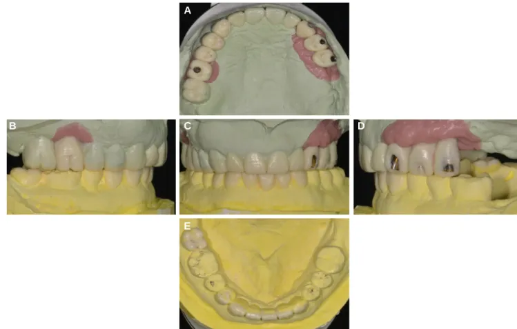 Fig. 4. Diagnostic wax-up. (A) Maxillary occlusal view, (B) Left lateral view at centric occlusion, (C) Frontal view at centric occlusion, (D) Right lateral view at centric occlusion, (E) Mandibular occlusal view.