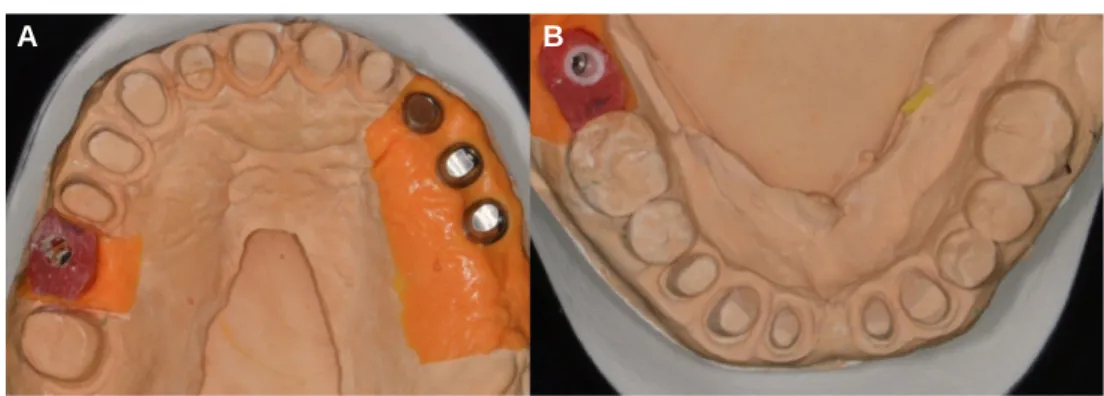 Fig. 6. Interocclusal relationship registrations using provisional restorations. (A) registration of provisional restoration, (B, C, D) registration of maxillary abutment, (E, F) registration of mandibular abutment.