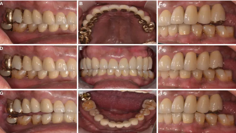 Fig. 11. Definitive prosthesis. (A) Working side during right lateral excursion, (B) Maxillary occlusal view, (C) Non-working side during right lateral excursion, (D) Left lateral view at centric occlusion, (E) Frontal view at centric occlusion, (F) Right 