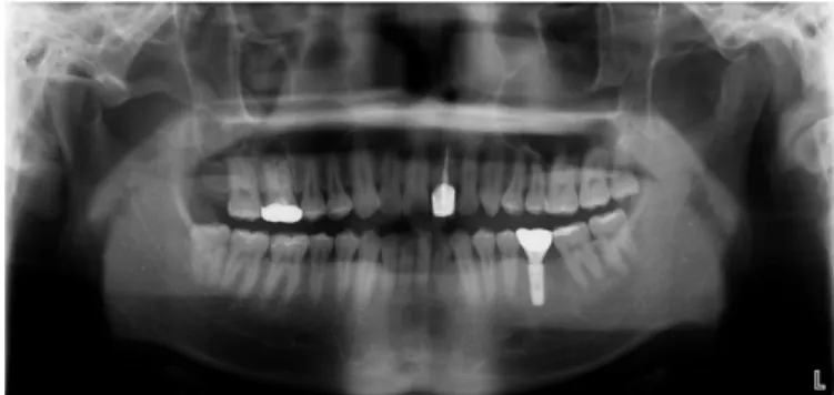 Fig. 2. Periapical X-ray taking at final setting of implant prosthesis. Fig. 3. Panoramic X-ray taking at final setting of implant prosthesis.