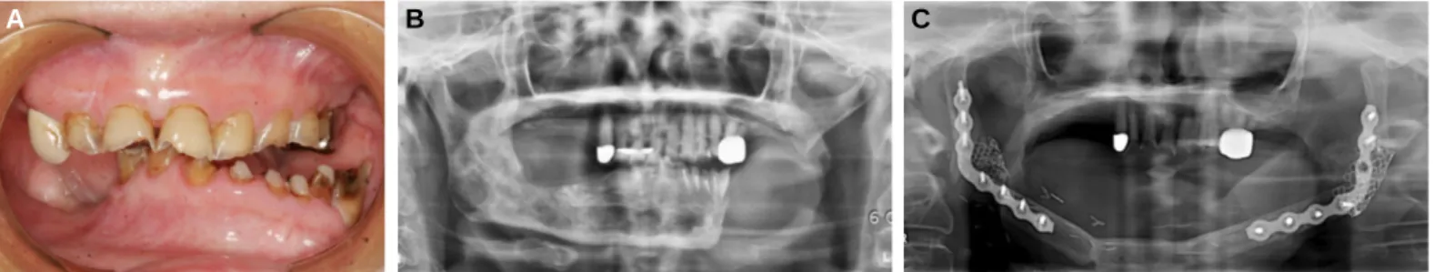 Fig. 2. Transcranial radiograph. Right and left TMJ at closing (A), 1 inch opening (B) and maximum opening (C).