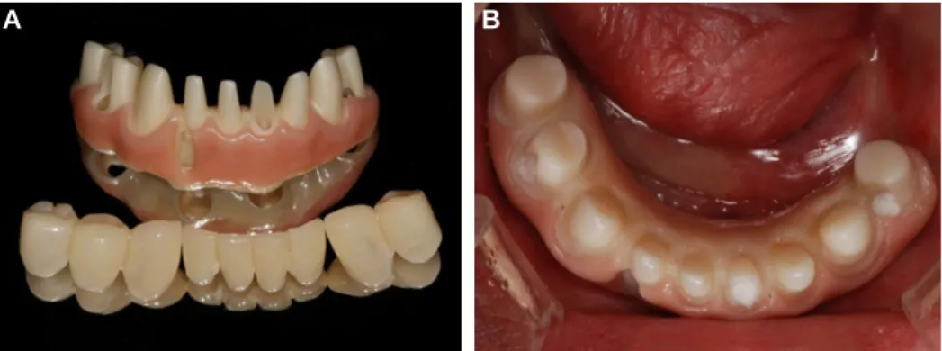 Fig. 6. (A) Monolithic zirconia framework and interim restorations, (B) Intraoral placement.