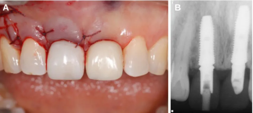 Fig. 3. (A) Immediate implant was placed and provisional restoration was connected on the right maxillary central incisor, (B) Periapical radiograph after provisional restora- restora-tions were connected.