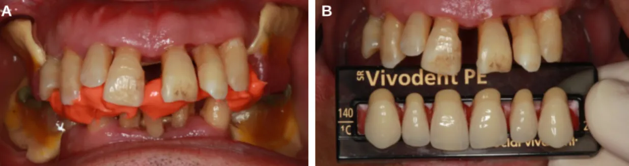 Fig. 4. (A) Bite registration, (B) Artificial teeth selection.