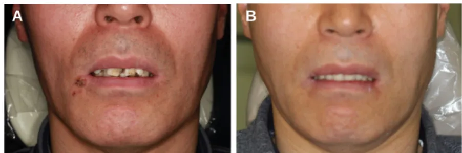 Fig. 8. Immediate denture delivery. Fig. 9. Extraoral view. (A) Before extraction, (B) After immediate denture delivery.