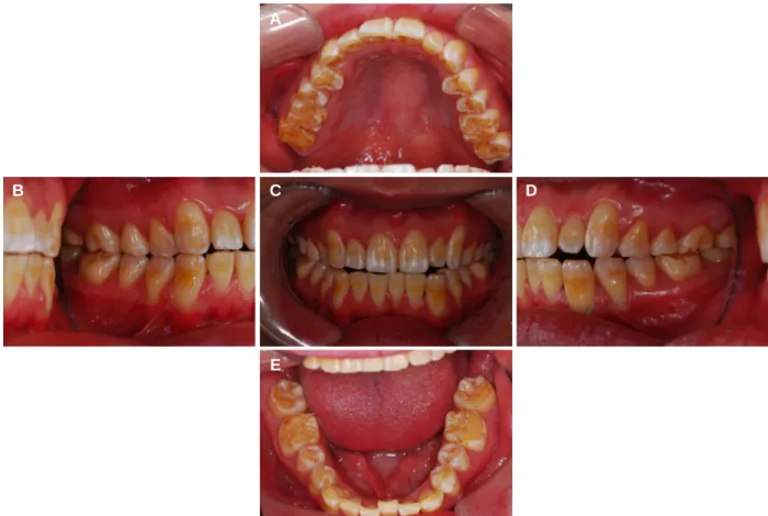 Fig. 1. Preoperative intraoral view showing generalized tooth wear and anterior open bite
