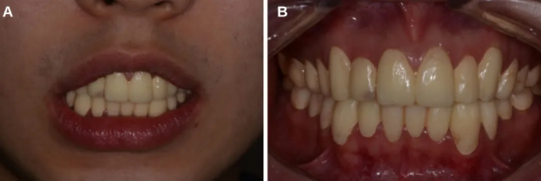 Fig. 7. CAD/CAM procedure for 2nd provisional prostheses. (A) Incisal edges and occlusal plane evaluation on virtual model, (B) Frontal view of maxillary crowns.