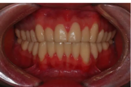 Fig. 10. Definitive restorations. (A) Frontal view, (B) Protrusive movement, (C) Right lateral excursion, (D) Left lateral excursion.