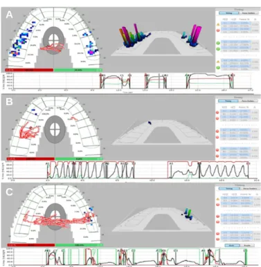 Fig. 6. T-Scan examination after maxillary anterior provisional restoration adjustment
