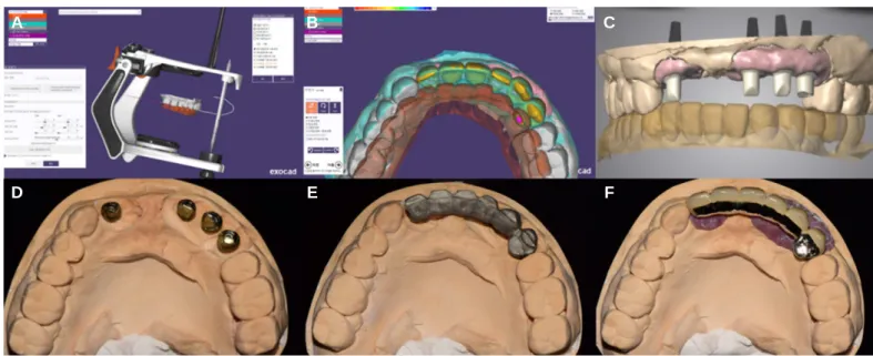 Fig. 7. Laboratory procedures using Exocad software. (A) Scanned provisional model (gray) and antagonistic teeth model (brown), (B) Superimposition and design of defin- defin-itive prosthesis, (C) Design of customized abutment, (D) Fabrication of titanium 