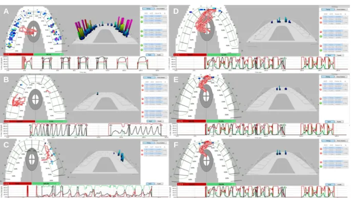 Fig. 10. T-scan examination after final restoration. (A) Occlusal contact was evenly distributed at Maximal Intercuspal Position (MICP) and the Center of Force (COF) was formed close to the center of the arch