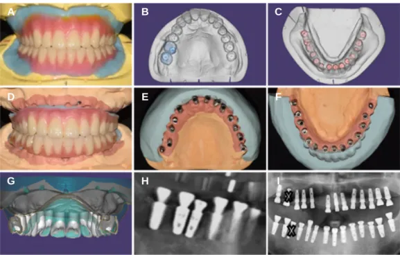 Fig. 7. (A) Diagnostic model and wax denture, (B) Maxillary implants location analysis using CAD, (C) Mandibular implants location analysis using CAD, (D) Working model and wax denture, (E) Maxillary implants path analysis using silicone index, (F) Mandibu