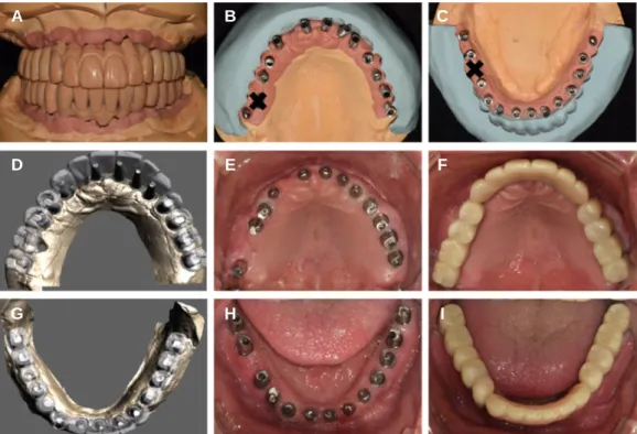 Fig. 8. 1 st fixed type provisional prostheses. (A) Wax pattern for provisional prostheses, (B) Implants path analysis using silicon index (maxilla), (C) Implants path analy- analy-sis using silicon index (mandible), (D) Computer aided design of customized