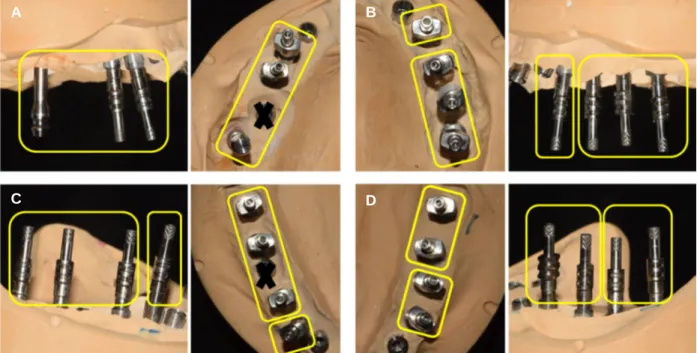 Fig. 12. Segmentaion for retrievability of posterior prostheses. (A) Right maxillary posterior implants, (B) Left maxillary posterior implants, (C) Right mandibular pos- pos-terior implants, (D) Left mandibular pospos-terior implants.