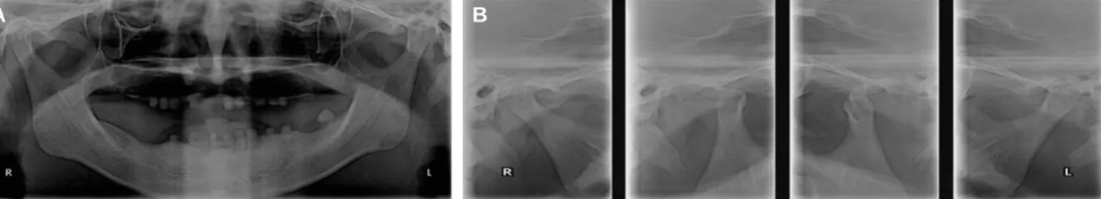 Fig. 2. Panoramic radiograph on first visit of patient. (A) Panoramic view, (B) Temporomandibular joint (TMJ) panoramic view