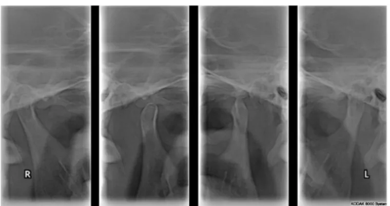Fig. 9. Temporomandibular joint (TMJ) panoramic view after delivery of final denture.