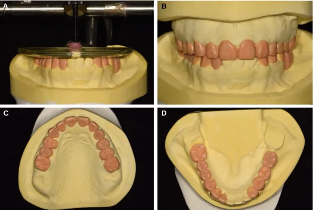 Fig. 3. Diagnostic wax-up. (A) Diagnostic wax-up using template system, (B) Frontal view, (C) Occlusal view of maxilla, (D) Occlusal view of mandible.
