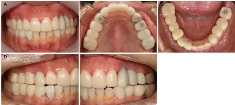 Fig. 6. Provisional restoration after modification. (A) Frontal view, (B) Occlusal view of maxilla, (C) Occlusal view of mandible, (D) Lateral view (eccentric position, left side) (E) Lateral view (eccentric position, right side).